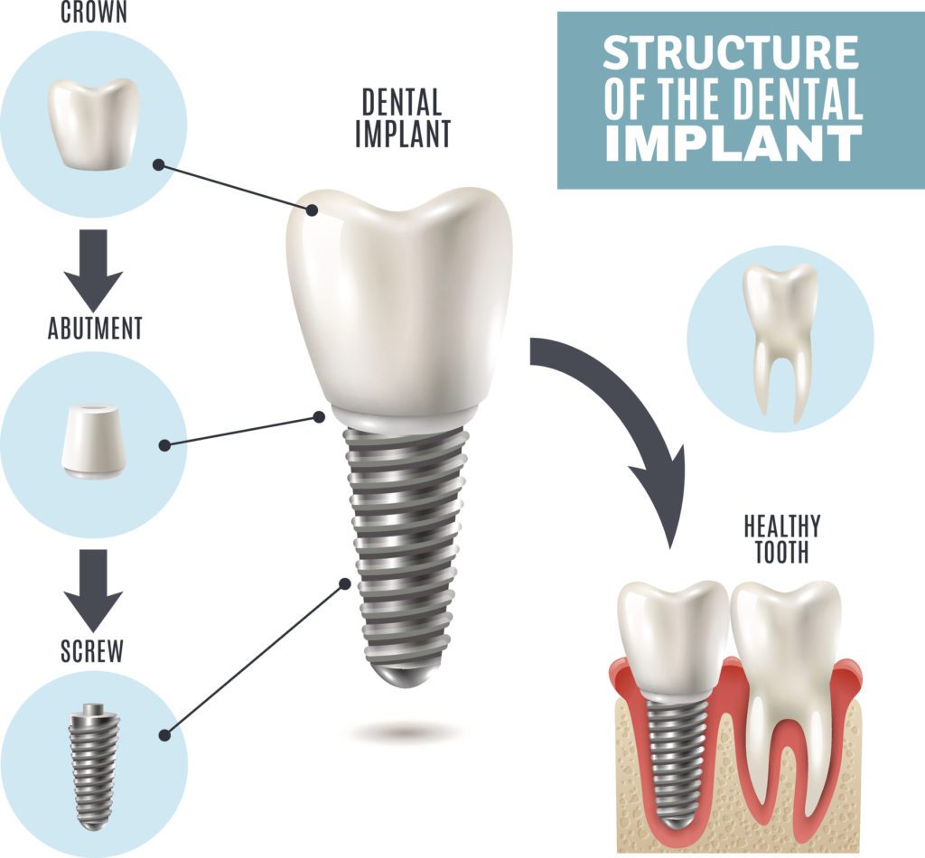 Dental Implant in Bladenboro, North Carolina