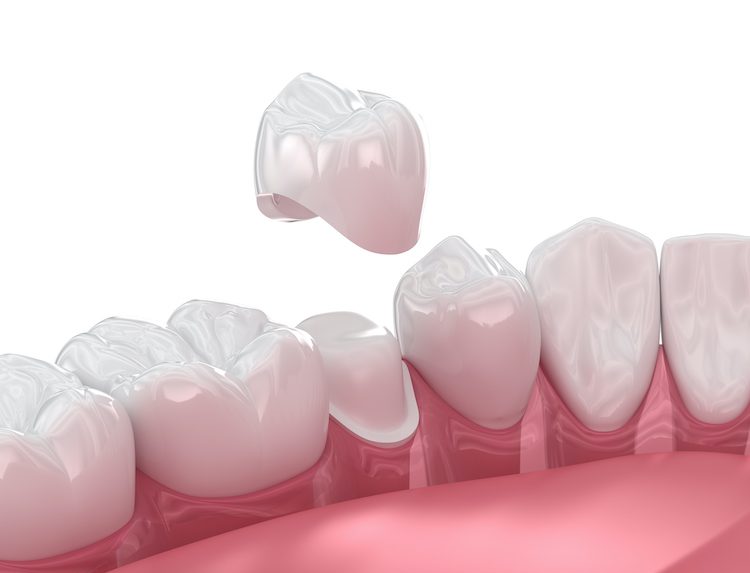 While it's not usually a dental emergency, losing a dental crown is something that should be addressed promptly.