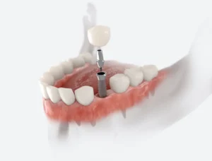 Understanding Dental Implants in Bladenboro, NC
