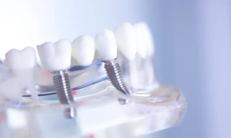 Dental Implants vs. Bridges: What's the Difference? in Bladenboro, NC